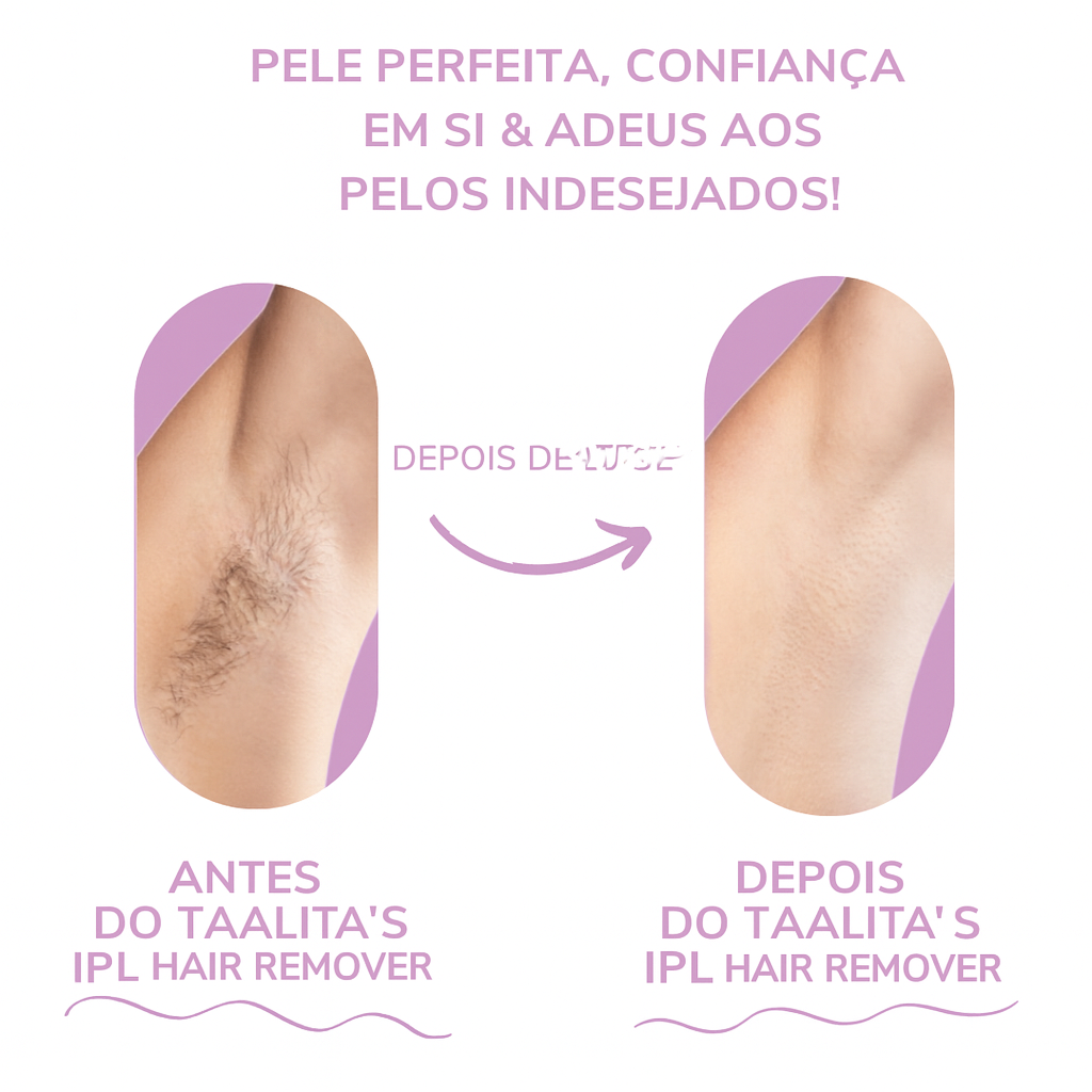Depilador IPL Taalitas I O depilador a laser líder para uso doméstico